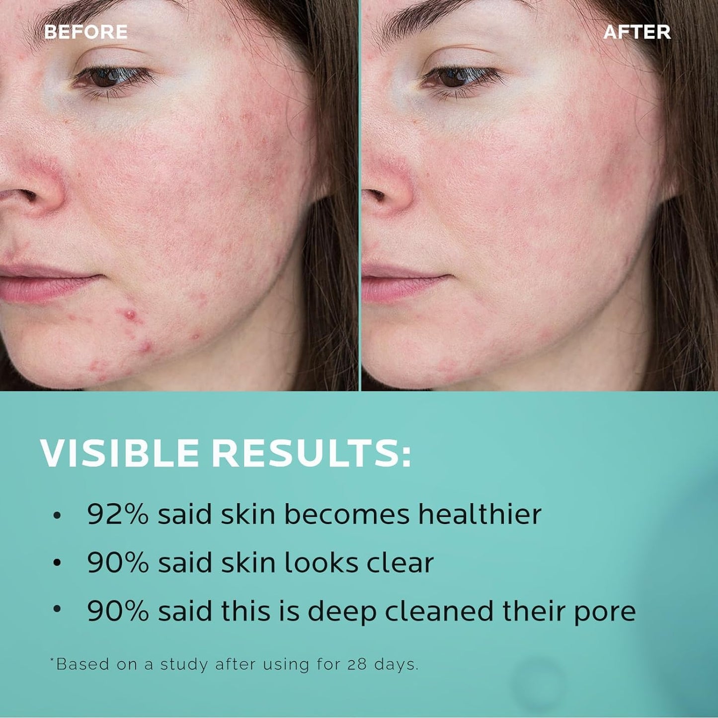 Face Toner - 2% Salicylic Acid- 2% Niacinamide - BHA Liquid Exfoliant -ZealSea