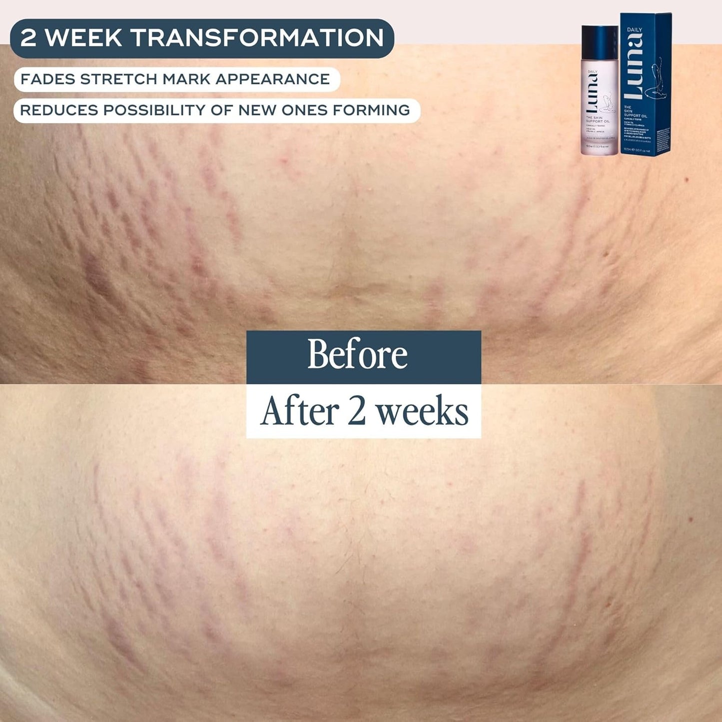 Skin Support Oil for Stretch Marks | Hydrating & Nourishing Body Oil
