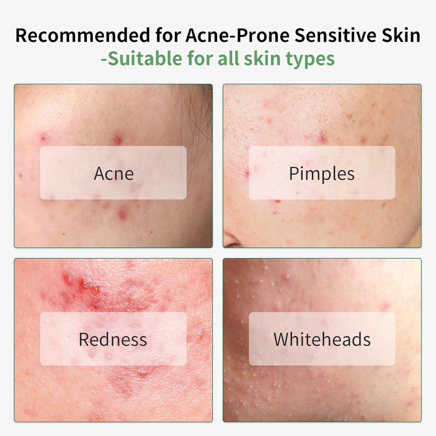 Acne Treatment Face Serum