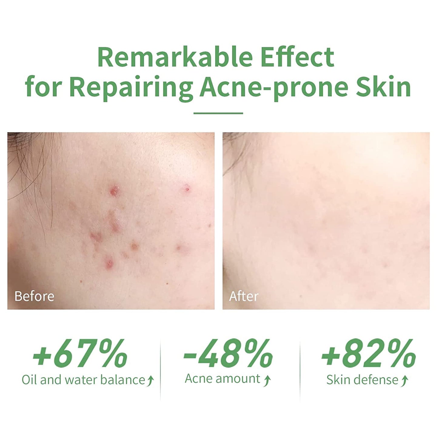 Acne Treatment Face Serum