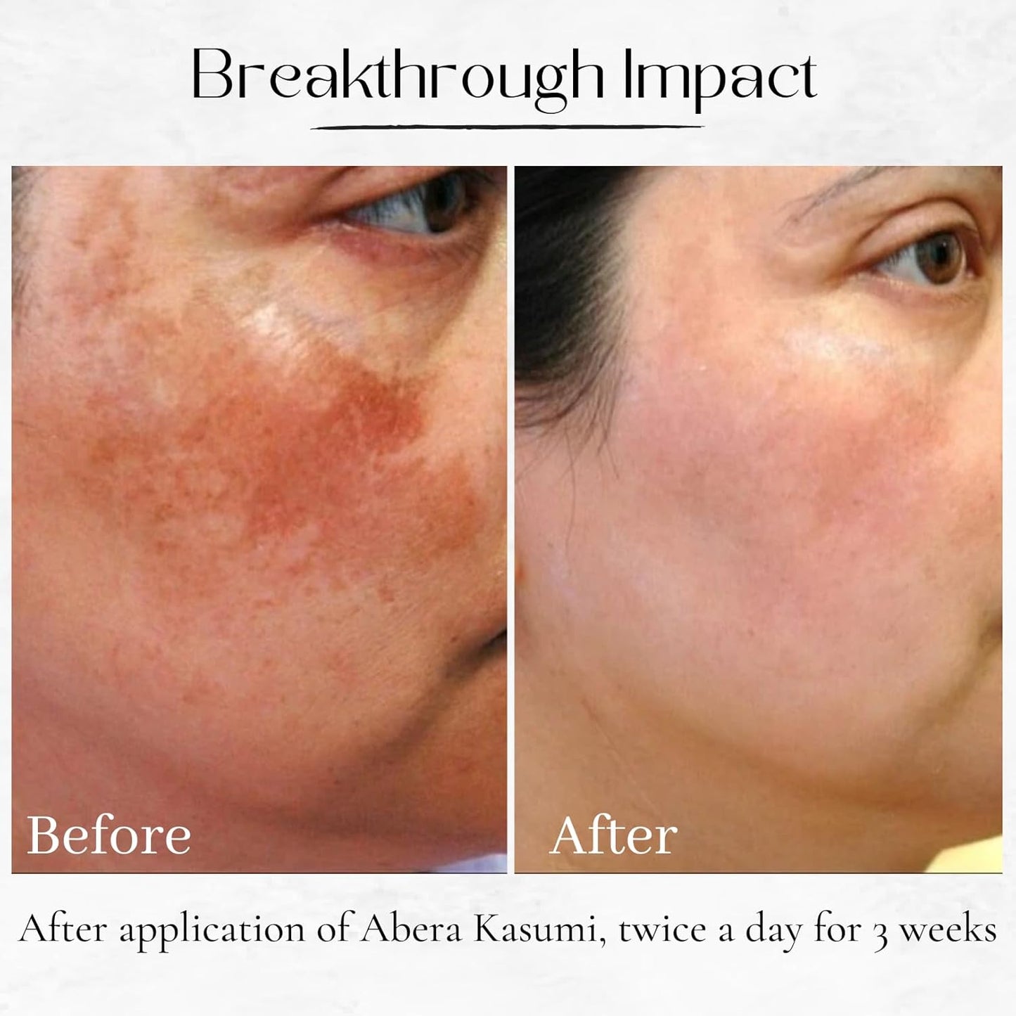ABERA Kasumi Glowing Cream, Melasma Treatment with Niacinamide & HA